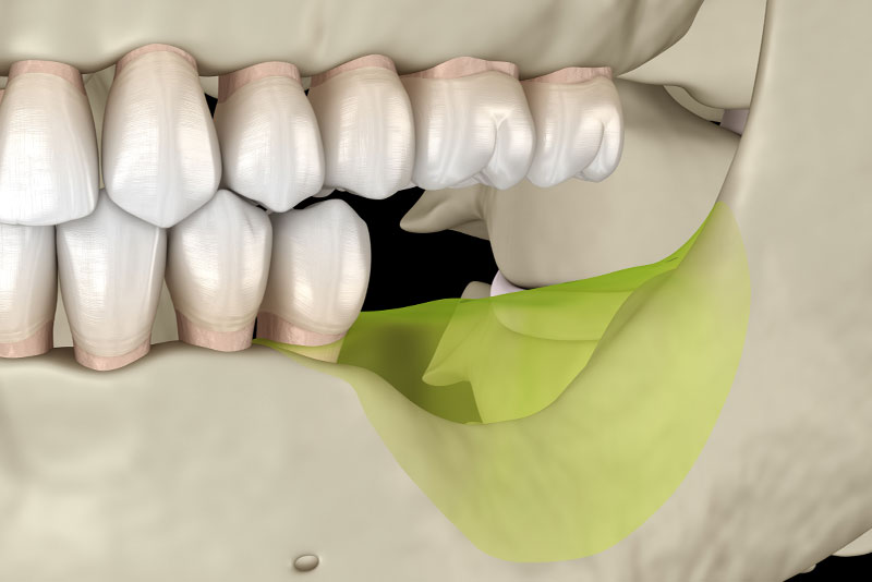 ridge augmentation graphic