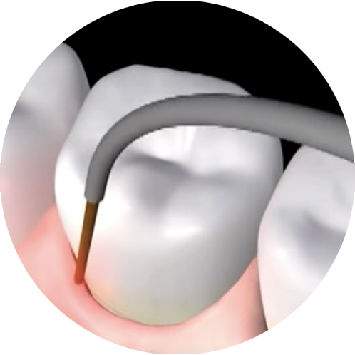tooth being cleaned with a dental laser