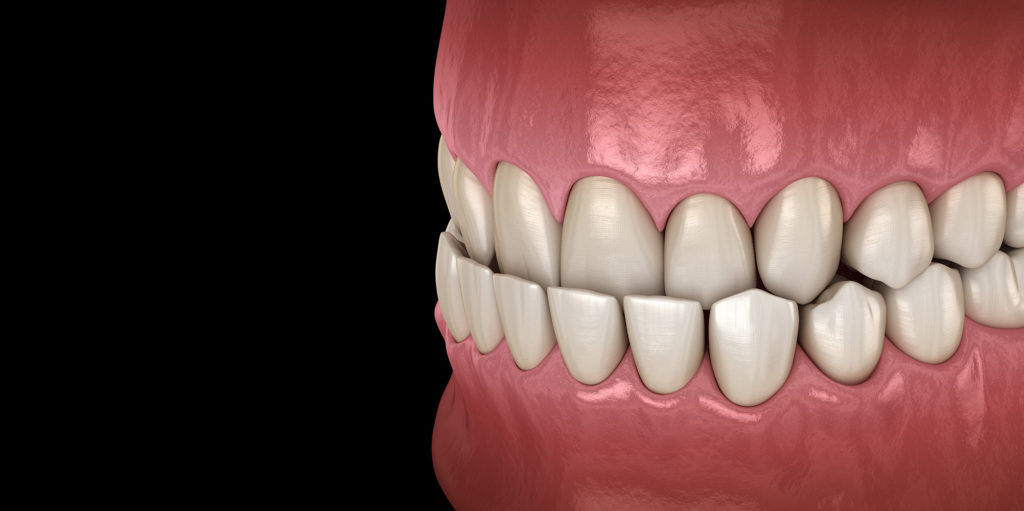 Underbite dental occlusion