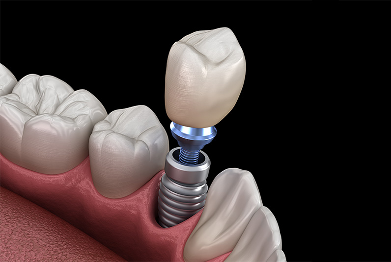 3d model of a single dental implants