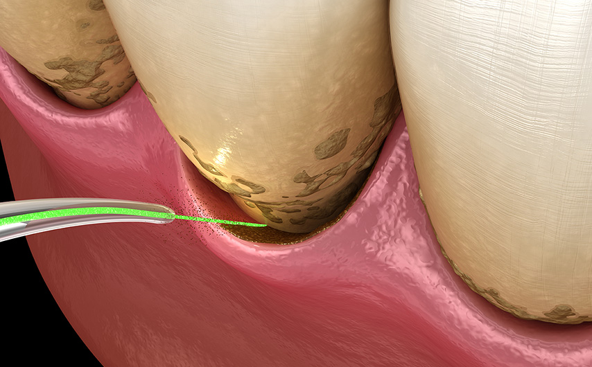 plaque being cleaned off teeth with dental laser