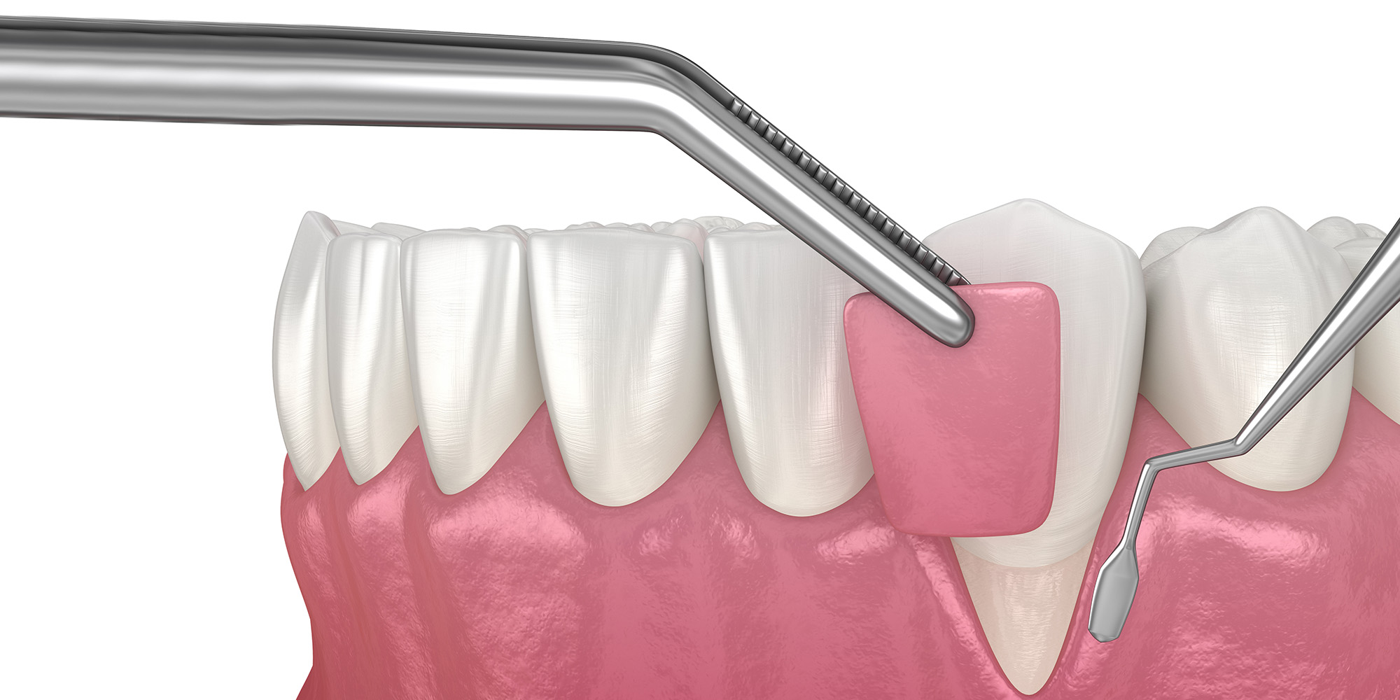 Gum Graft Provo, UT Gum Recession Treatment Sundance Periodontal