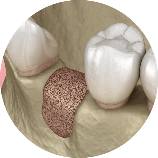 bone graft on jaw