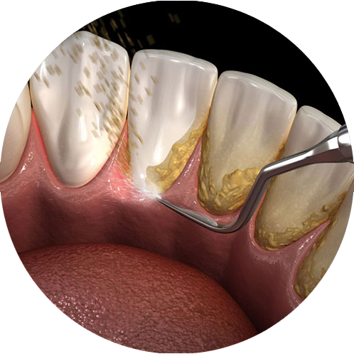 plaque all over teeth being cleaned