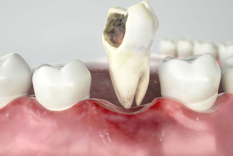tooth extraction of infected tooth
