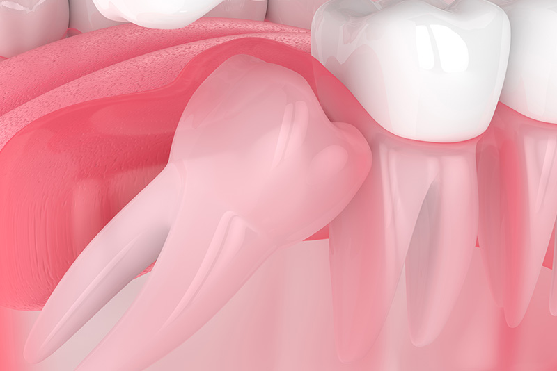 impacted wisdom tooth 3d model