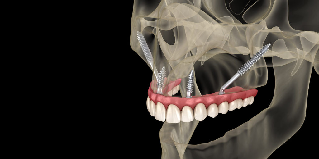 zygomatic implants