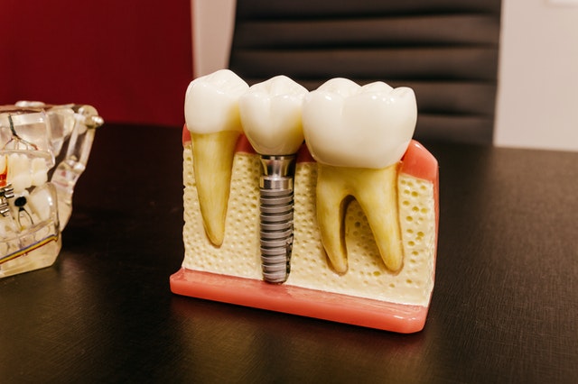 Dental implants vs. dentures: Which should you choose?