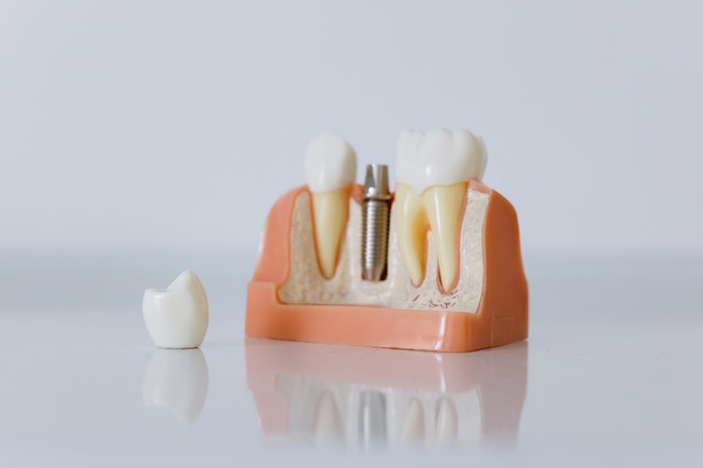 Everything You Should Know About Dental Implant Surgery