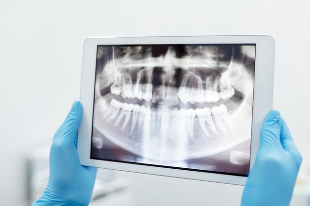 Ridge Augmentation and Socket Preservation