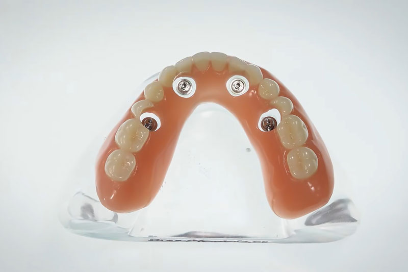 The Longevity of Dental Implants: A Detailed Insight by Dr. Jason Nicholson