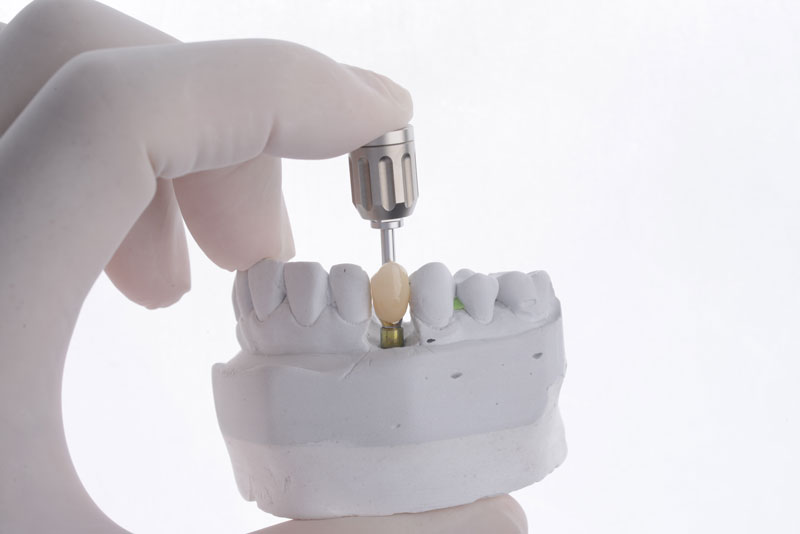 Navigate Your Way to a Winning Smile: Dental Implants in Mapleton