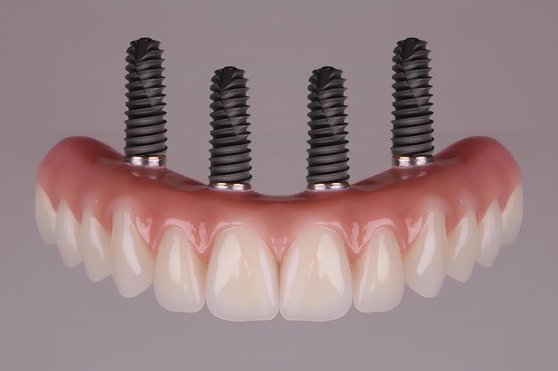 Do’s and Don’ts: Navigating Your Journey to Dental Implants in Provo, UT